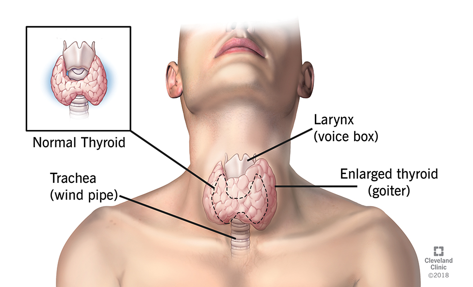 tiroide-gozzo1